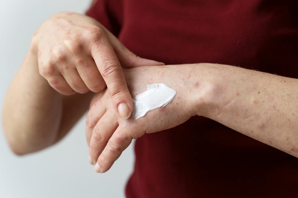 Tratamentul dermatitei atopice