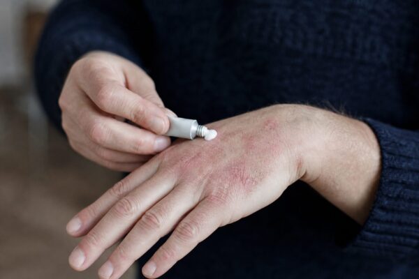 Alergia la geluri: cum recunoști primele semne